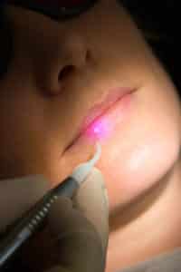 Aphten lasern