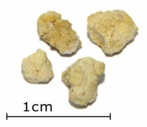 Speichelsteine