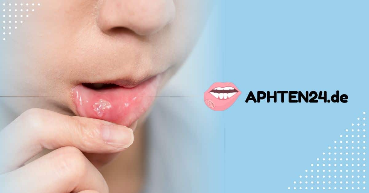Aphten Symptome, Ursachen und Behandlungsmethoden