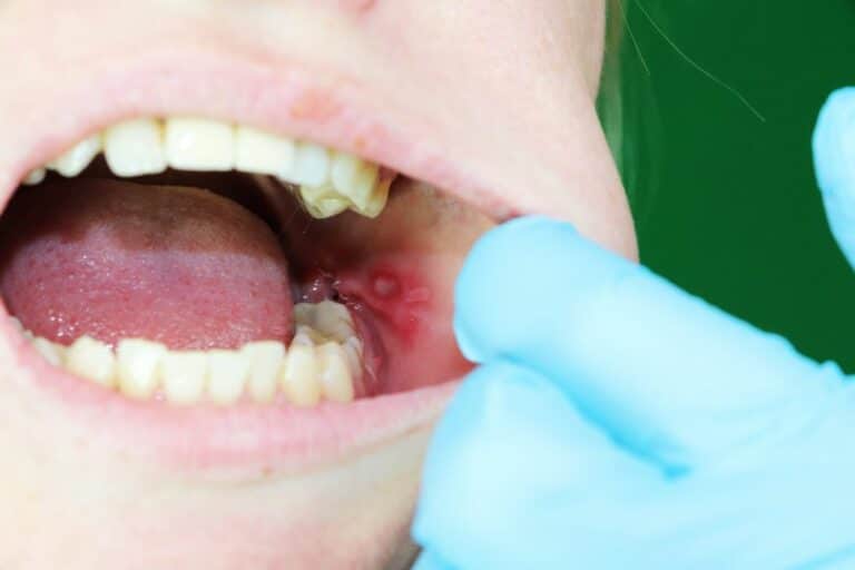 Entzündung an der Lippe Symptome, Ursachen und Behandlung