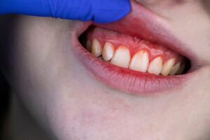 Entzündung am Zahnfleisch