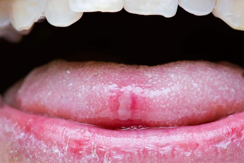 Entzündung auf der Zunge